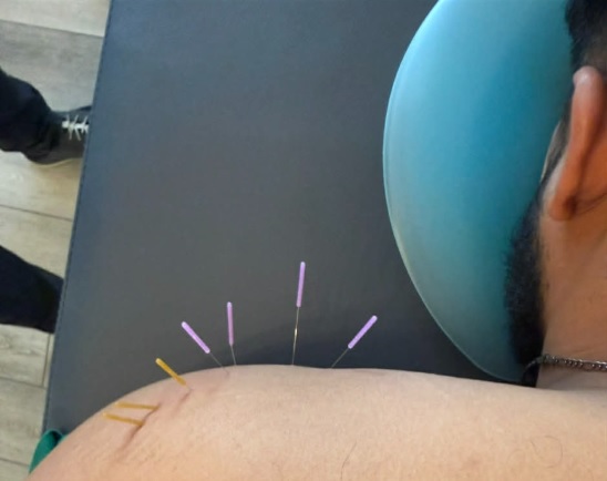 Dry Needling Jacksonville FL